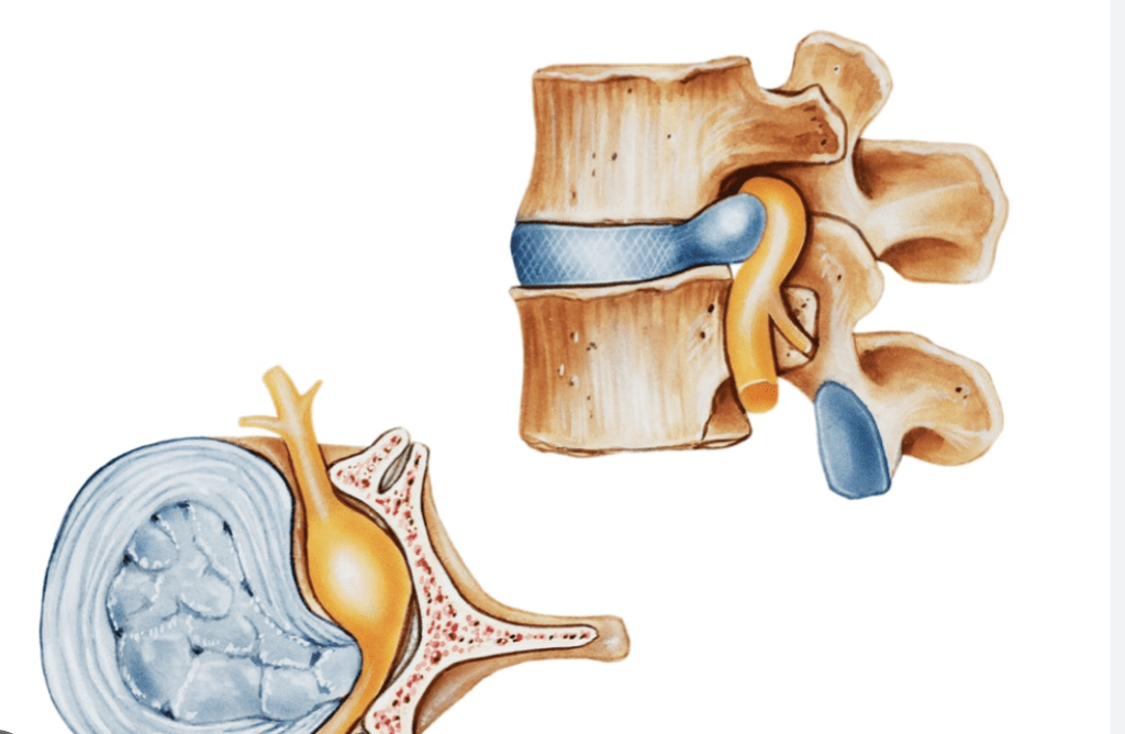 Effective Herniated Disc Treatment - starbiosource.com