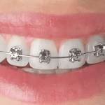 Expert Orthodontist Treatment in Rhode Island